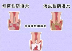 全自动阴道分泌物蜜桃视频在线观看免费厂家提醒您还在拖延吗，还在等阴道炎自愈吗？